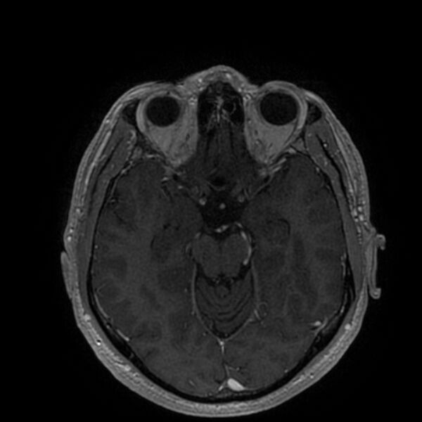 File:Acoustic schwannoma - intracanalicular (Radiopaedia 37247-39024 Axial T1 C+ 102).jpg
