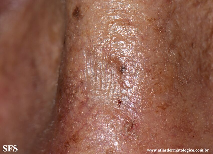 Actinic Keratosis-Atrophic Actinic Keratosis (Dermatology Atlas 3).jpg