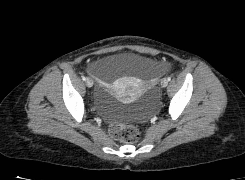 File:Acute Budd-Chiari syndrome (Radiopaedia 60858-68638 Axial C+ portal venous phase 259).jpg