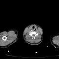 Acute aspiration pneumonitis (Radiopaedia 33605-34703 Axial non-contrast 3).jpg