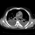 Acute aspiration pneumonitis (Radiopaedia 33605-34703 Axial non-contrast 45).jpg