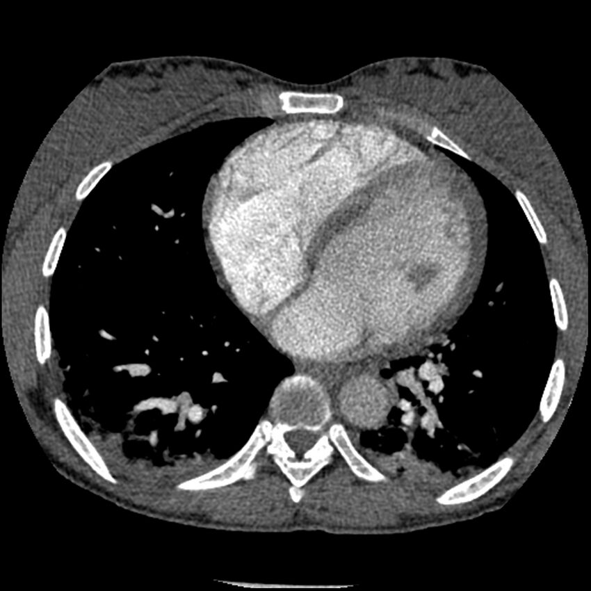 Acute chest syndrome - sickle cell disease (Radiopaedia 42375-45499 Axial C+ CTPA 121).jpg