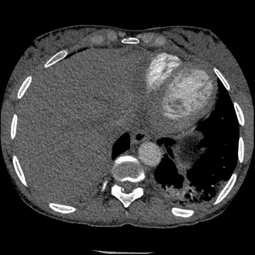 Acute chest syndrome - sickle cell disease (Radiopaedia 42375-45499 Axial C+ CTPA 156).jpg