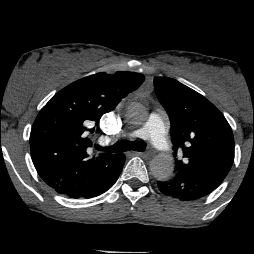 Acute chest syndrome - sickle cell disease (Radiopaedia 42375-45499 Axial C+ CTPA 68).jpg