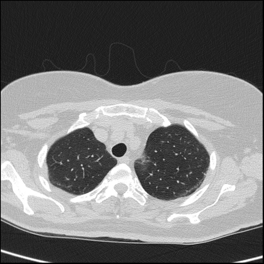 Acute interstitial pneumonitis (Radiopaedia 45404-49453 Axial lung window 17).jpg