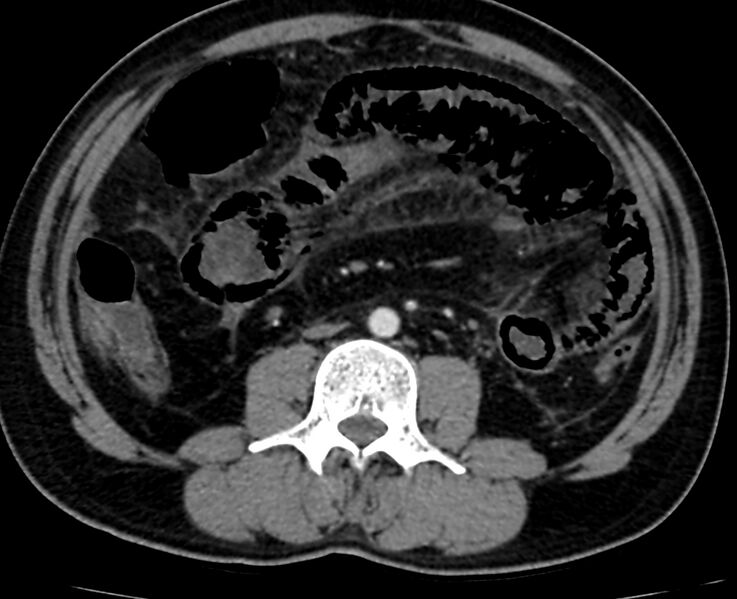 File:Acute mesenteric ischemia - superior mesenteric artery thrombosis (Radiopaedia 73947-84776 Axial C+ arterial phase 72).jpg
