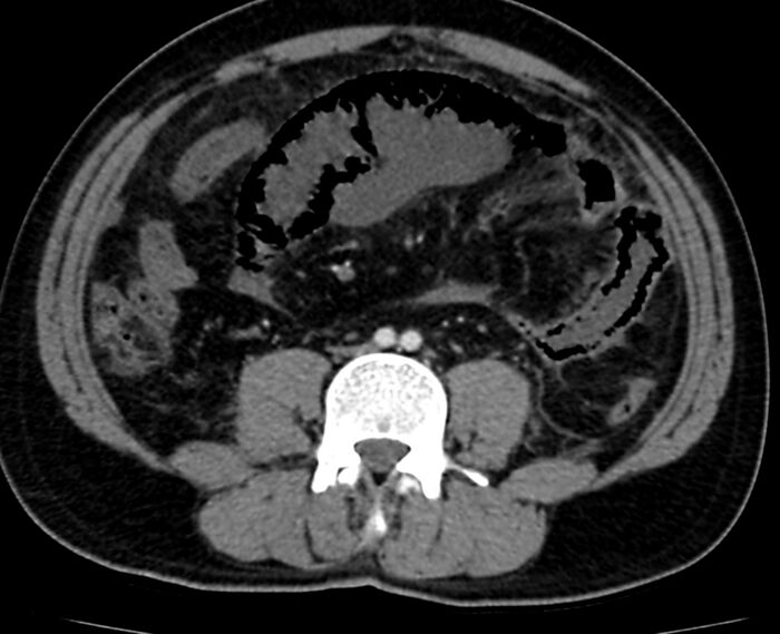 Acute mesenteric ischemia - superior mesenteric artery thrombosis (Radiopaedia 73947-84776 Axial C+ arterial phase 87).jpg