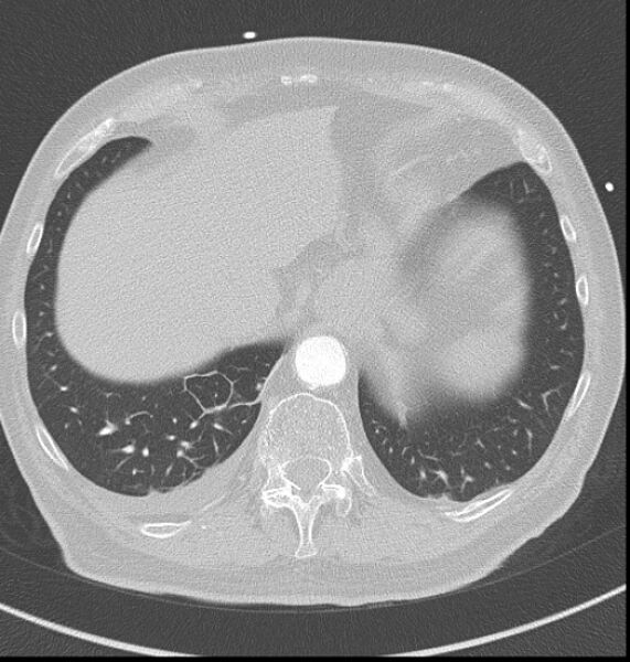 File:Acute myocardial infarction (Radiopaedia 23413-23481 lung window 63).jpg