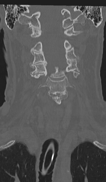 File:Acute on chronic subdural hematoma and thoracic vertebral injury in a multitrauma patient (Radiopaedia 31698-32619 Coronal bone window 22).jpg