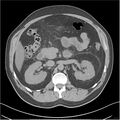 Acute pancreatitis - mild (Radiopaedia 27796-28033 Axial non-contrast 15).jpg