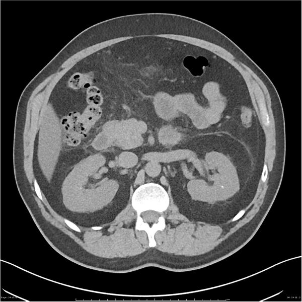 File:Acute pancreatitis - mild (Radiopaedia 27796-28033 Axial non-contrast 15).jpg