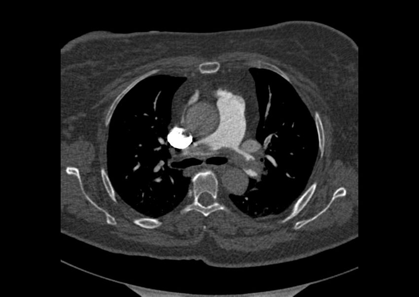 Acute pulmonary embolism (Radiopaedia 29938-30466 Axial C+ CTPA 45).jpg