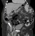Acute renal failure post IV contrast injection- CT findings (Radiopaedia 47815-52559 Coronal C+ portal venous phase 6).jpg