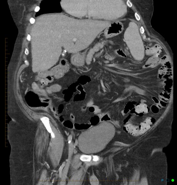 File:Acute renal failure post IV contrast injection- CT findings (Radiopaedia 47815-52559 Coronal C+ portal venous phase 6).jpg