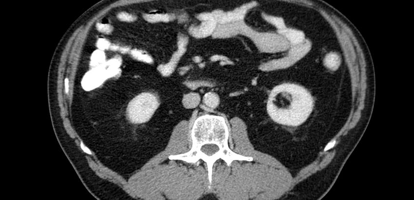 Acute sigmoid colon diverticulitis (Radiopaedia 55507-61976 Axial C+ portal venous phase 7).jpg