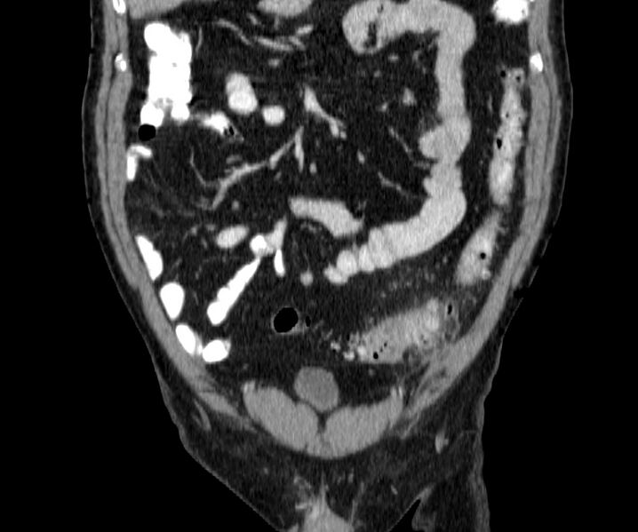 File:Acute sigmoid colon diverticulitis (Radiopaedia 55507-61976 Coronal C+ portal venous phase 35).jpg