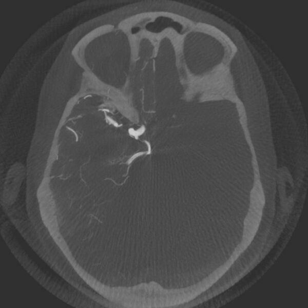 File:Acute subarachnoid hemorrhage and accessory anterior cerebral artery (Radiopaedia 69231-79010 Axial arterial - MIP 28).jpg