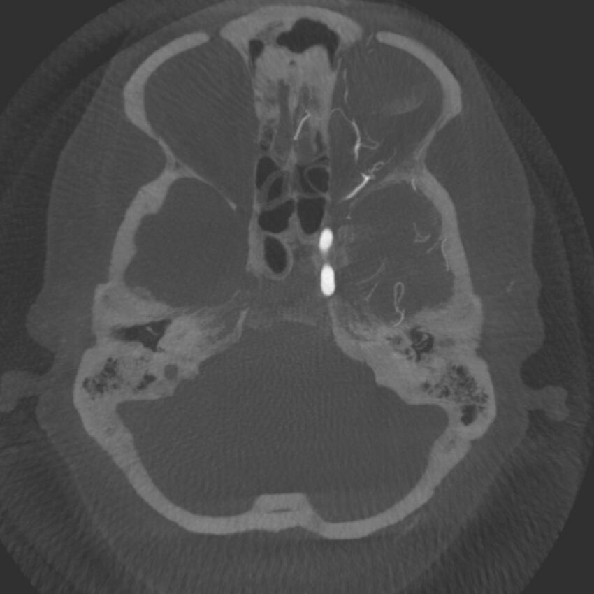 Acute subarachnoid hemorrhage and accessory anterior cerebral artery (Radiopaedia 69231-79010 C 12).jpg