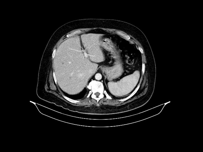 File:Adenocarcinoma of pancreas with hepatic metastasis (Radiopaedia 64332-73122 Axial C+ portal venous phase 24).jpg