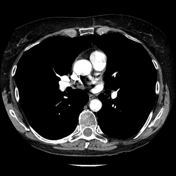 File:Adenocarcinoma of the lung (Radiopaedia 41015-43755 Axial C+ portal venous phase 60).jpg