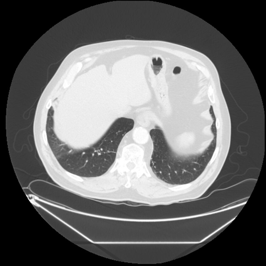 Adenocarcinoma of the lung (Radiopaedia 44876-48759 Axial lung window 68).jpg