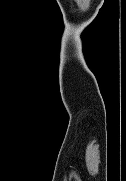File:Adhesional small bowel obstruction (Radiopaedia 58900-66131 Sagittal C+ portal venous phase 253).jpg