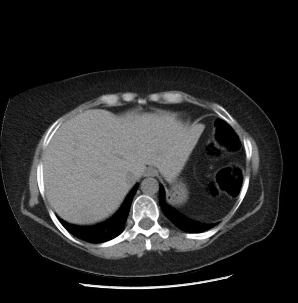 File:Adrenal cortical carcinoma with IVC invasion and thrombosis (Radiopaedia 34307-35597 Axial non-contrast 1).jpg
