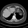 Adrenal hemangioma (Radiopaedia 33078-34103 Axial non-contrast 4).png