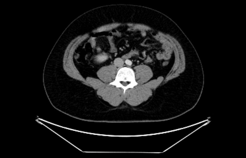 File:Adrenocortical carcinoma (Radiopaedia 80134-93438 Axial C+ portal venous phase 78).jpg