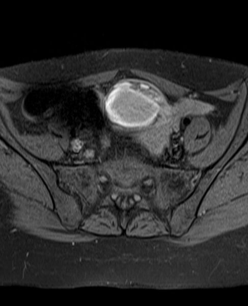 File:Adult granulosa cell tumor of the ovary (Radiopaedia 71581-81950 Axial T1 fat sat 9).jpg