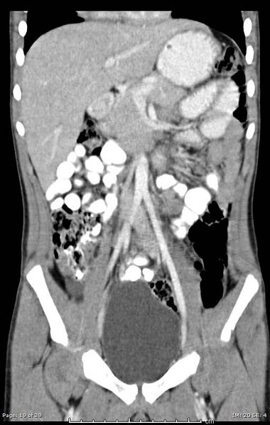 File:Agenesis of the gallbladder (Radiopaedia 55454-61905 Coronal 3).jpg