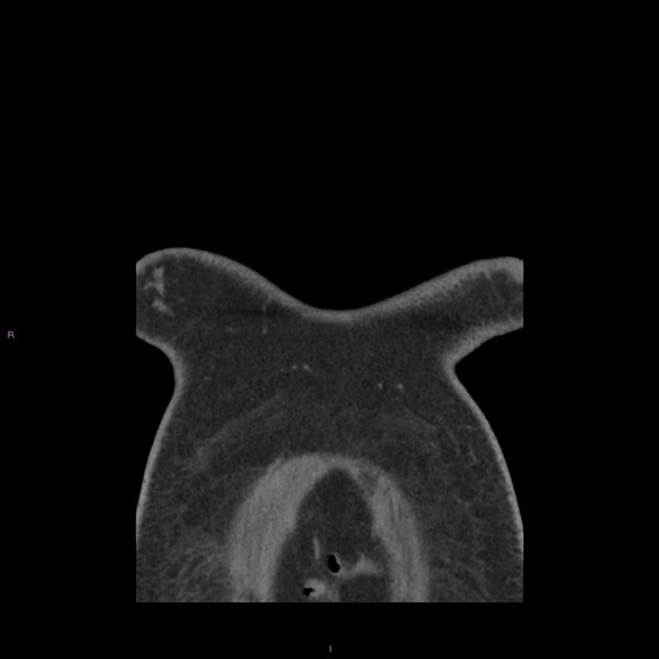 File:Agenesis of the left hepatic lobe (Radiopaedia 77284-89359 Coronal C+ CTPA 84).jpg