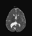 Aicardi syndrome (Radiopaedia 66029-75205 Axial ADC 13).jpg