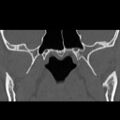 Ameloblastic fibro-odontoma (Radiopaedia 18843-18780 B 24).jpg