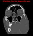 Ameloblastoma (Radiopaedia 13276-13280 Coronal non-contrast 9).jpg