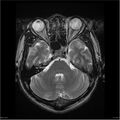 Amnestic syndrome secondary to hypoxic brain injury (Radiopaedia 24743-25004 T2 6).jpg