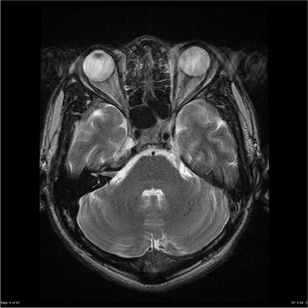 File:Amnestic syndrome secondary to hypoxic brain injury (Radiopaedia 24743-25004 T2 6).jpg