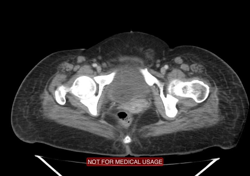 Amoebic enterocolitis with liver abscess (Radiopaedia 35100-36609 A 80).jpg