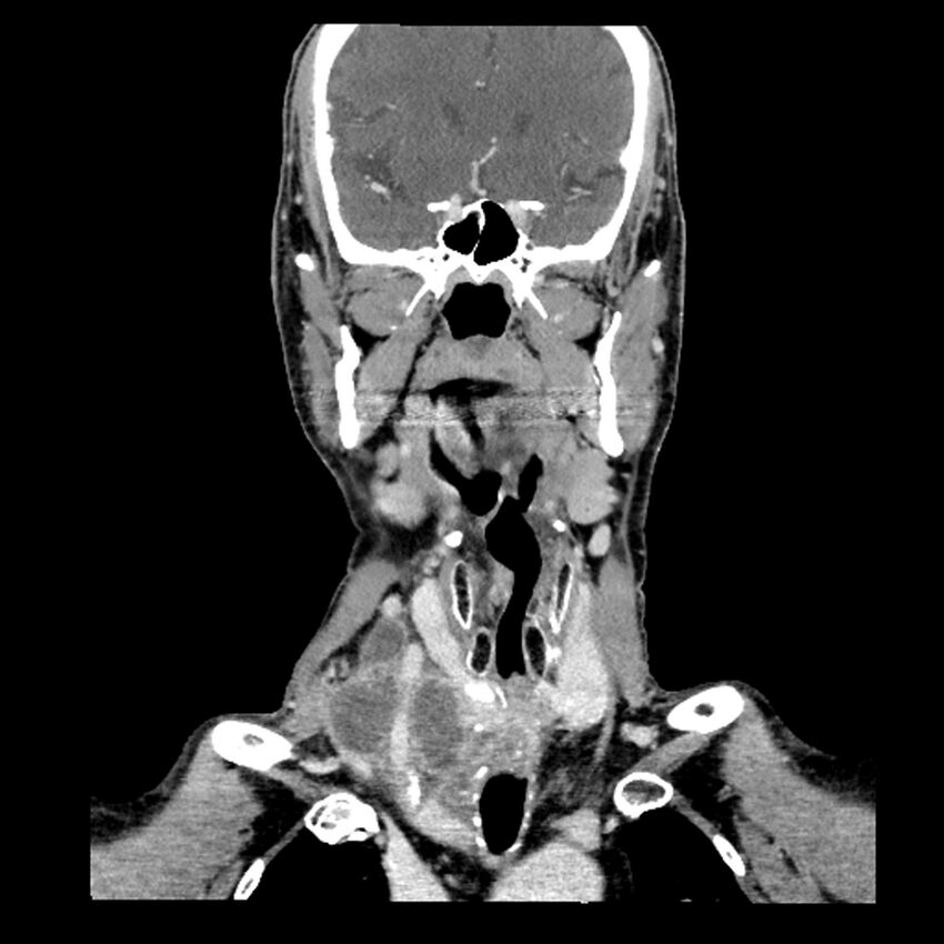 Anaplastic thyroid carcinoma (Radiopaedia 79087-92034 A 55).jpg