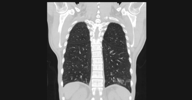 File:Angioinvasive aspergellosis (Radiopaedia 66995-76315 Coronal lung window 49).jpg