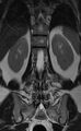 Ankylosing spondylitis - Andersson lesion (Radiopaedia 81878-95838 Coronal T2 10).jpg