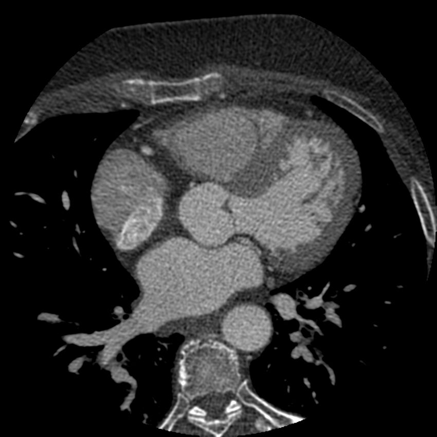 Anomalous origin of left circumflex artery from right coronary sinus (Radiopaedia 72563-83117 B 71).jpg