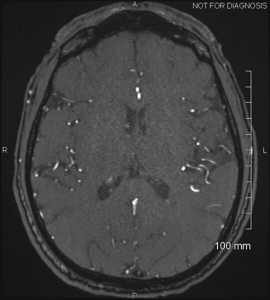 File:Anterior cerebral artery aneurysm (Radiopaedia 80683-94127 Axial MRA 140).jpg