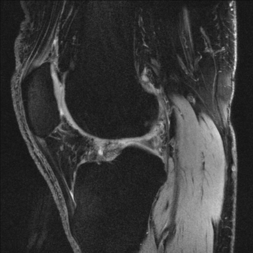 Anterior cruciate ligament mucoid degeneration (Radiopaedia 68400-77933 Sagittal 25).jpg