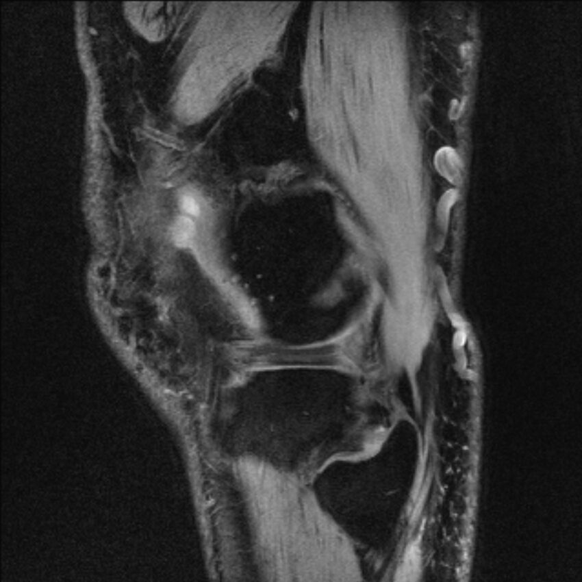 Anterior cruciate ligament mucoid degeneration (Radiopaedia 68400-77933 Sagittal 6).jpg