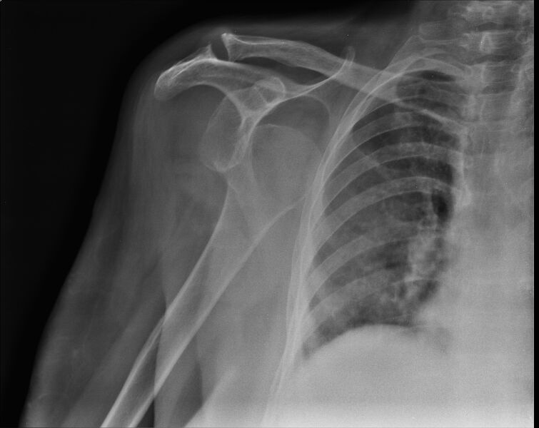 File:Anterior shoulder dislocation - ultrasound (Radiopaedia 23060-23091 Frontal 1).jpg