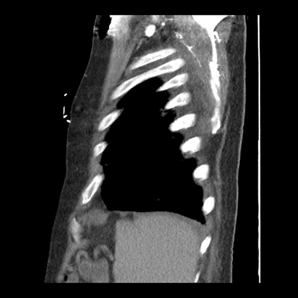 File:Aortic arch graft infection (FDG PET-CT) (Radiopaedia 71975-82437 C 59).jpg