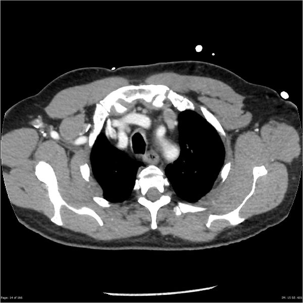 File:Aortic dissection- Stanford A (Radiopaedia 37759-39664 A 5).jpg