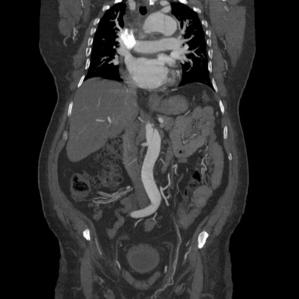 File:Aortic dissection (Radiopaedia 28802-29105 B 15).jpg