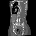 Aortic dissection (Radiopaedia 68763-78691 B 29).jpeg